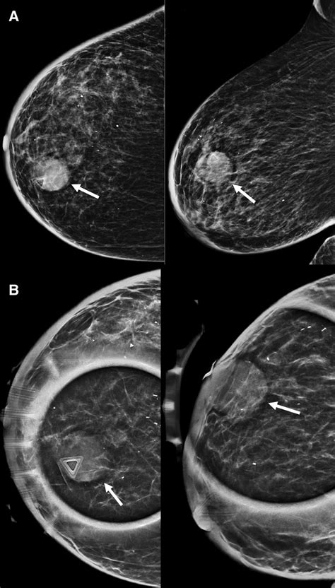 mammography biweekely compression test|mammogram results 6 months.